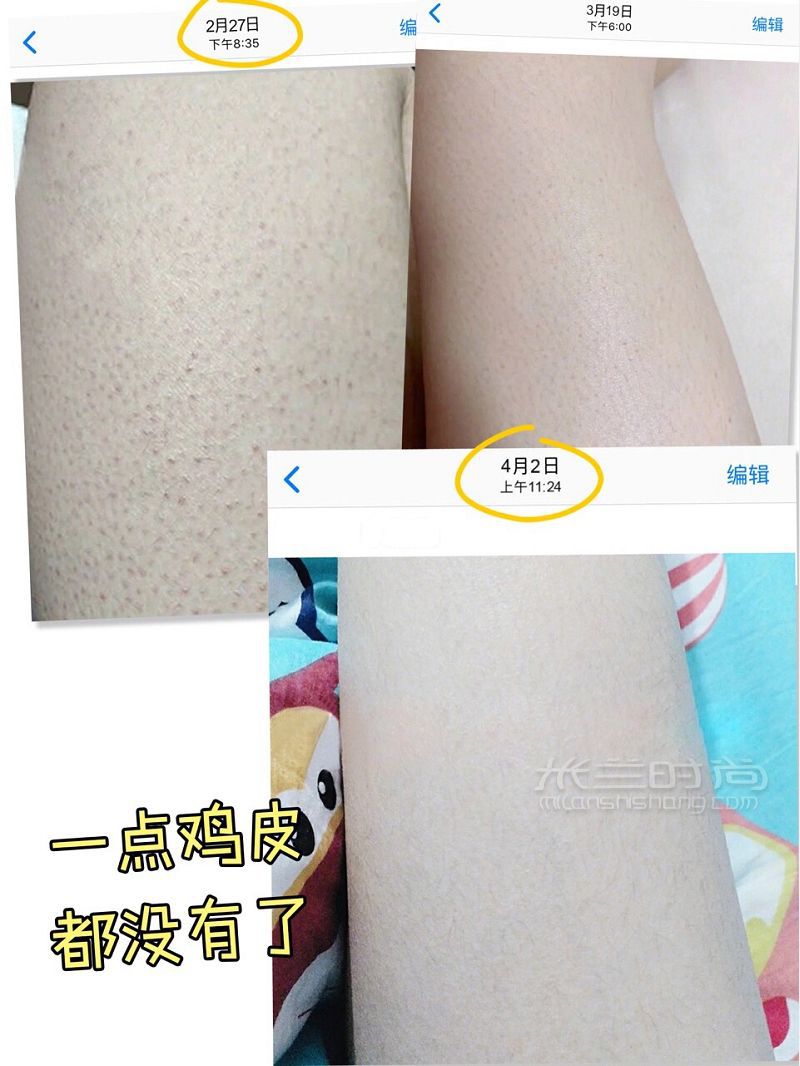 怎么解決最難纏的雞皮膚 效果快到讓我直呼！_2
